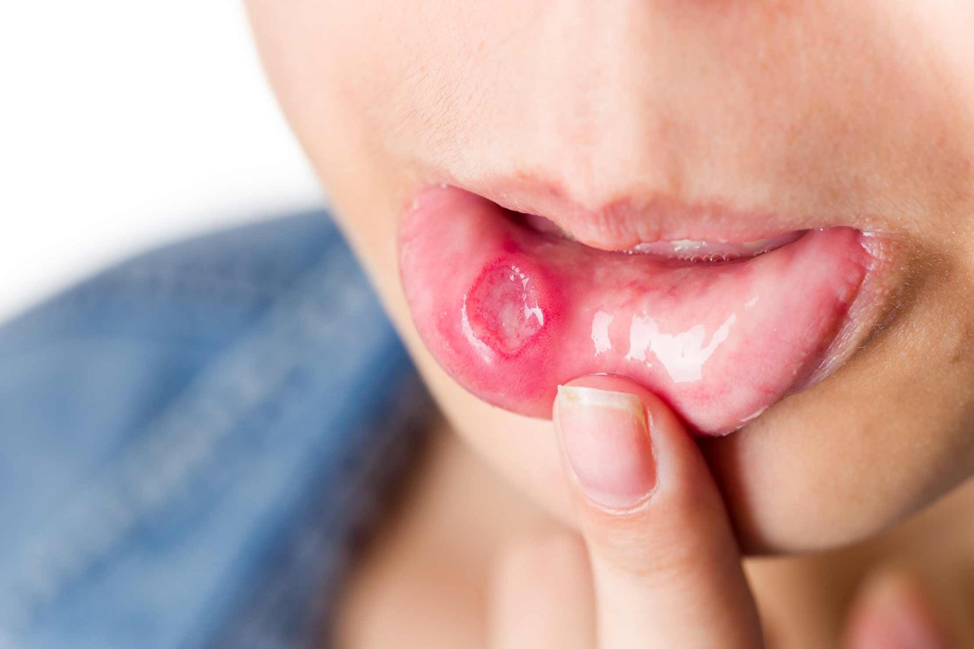 mouth ulcer treatment