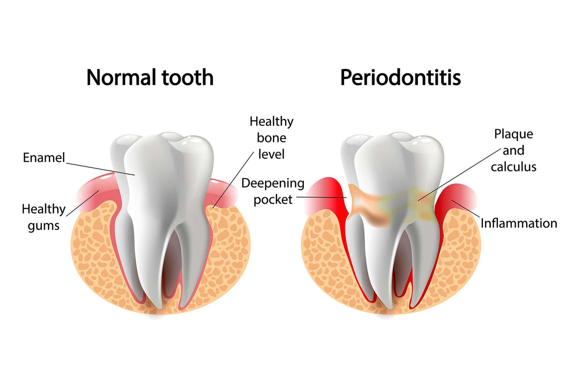 traitement parodontal