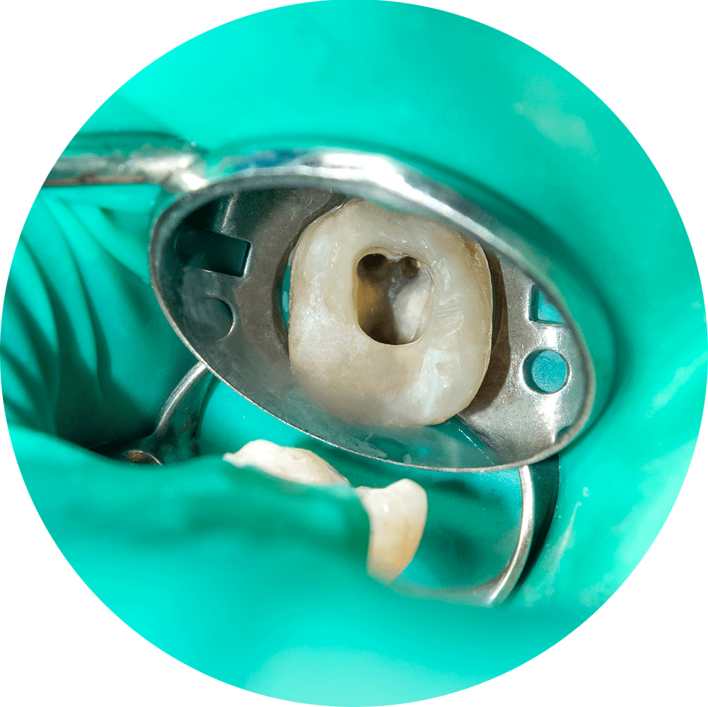 tooth isolation