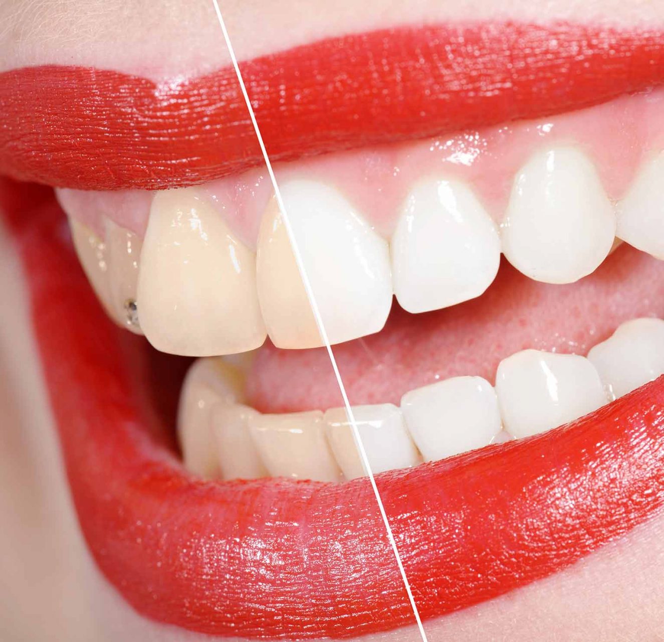 Comparison before and after tooth whitening