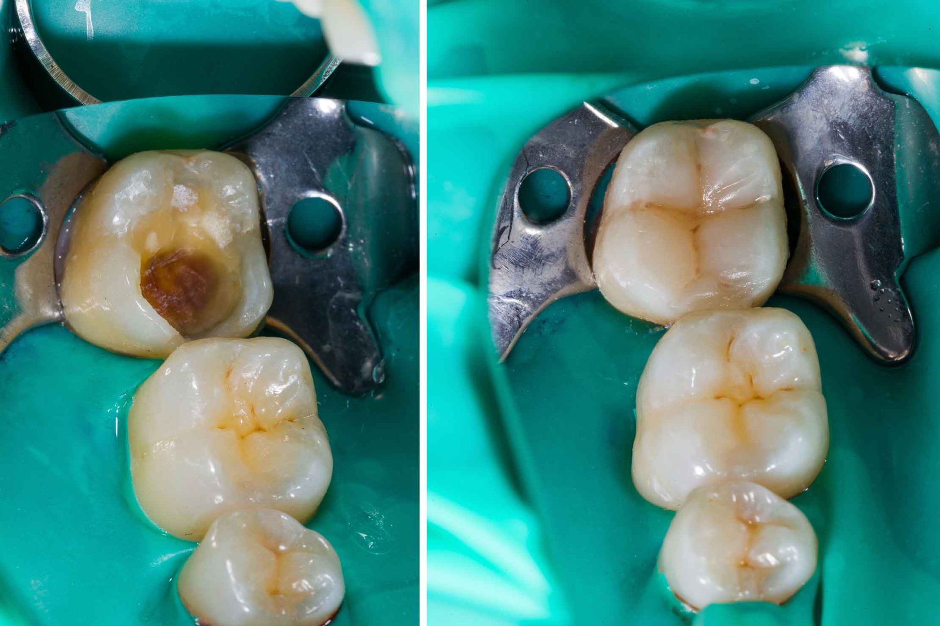 composite fillings