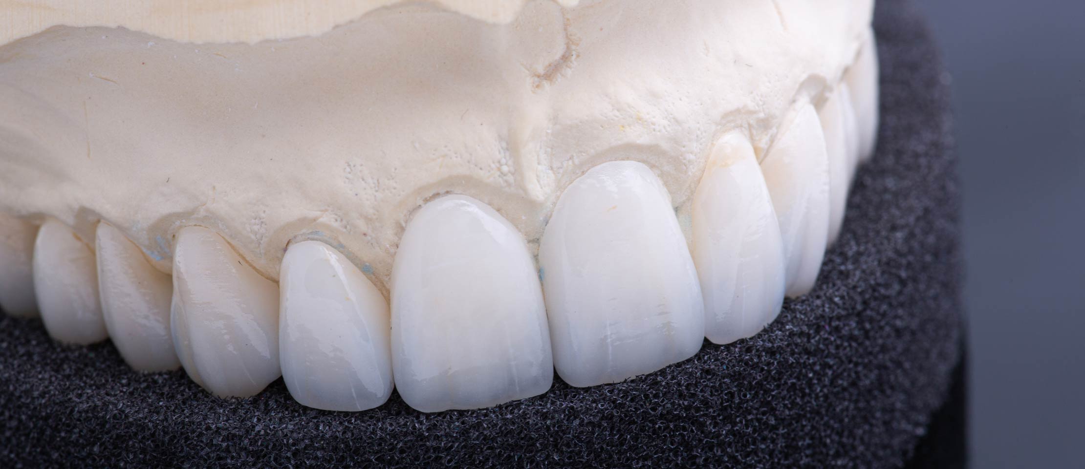 dental veneers