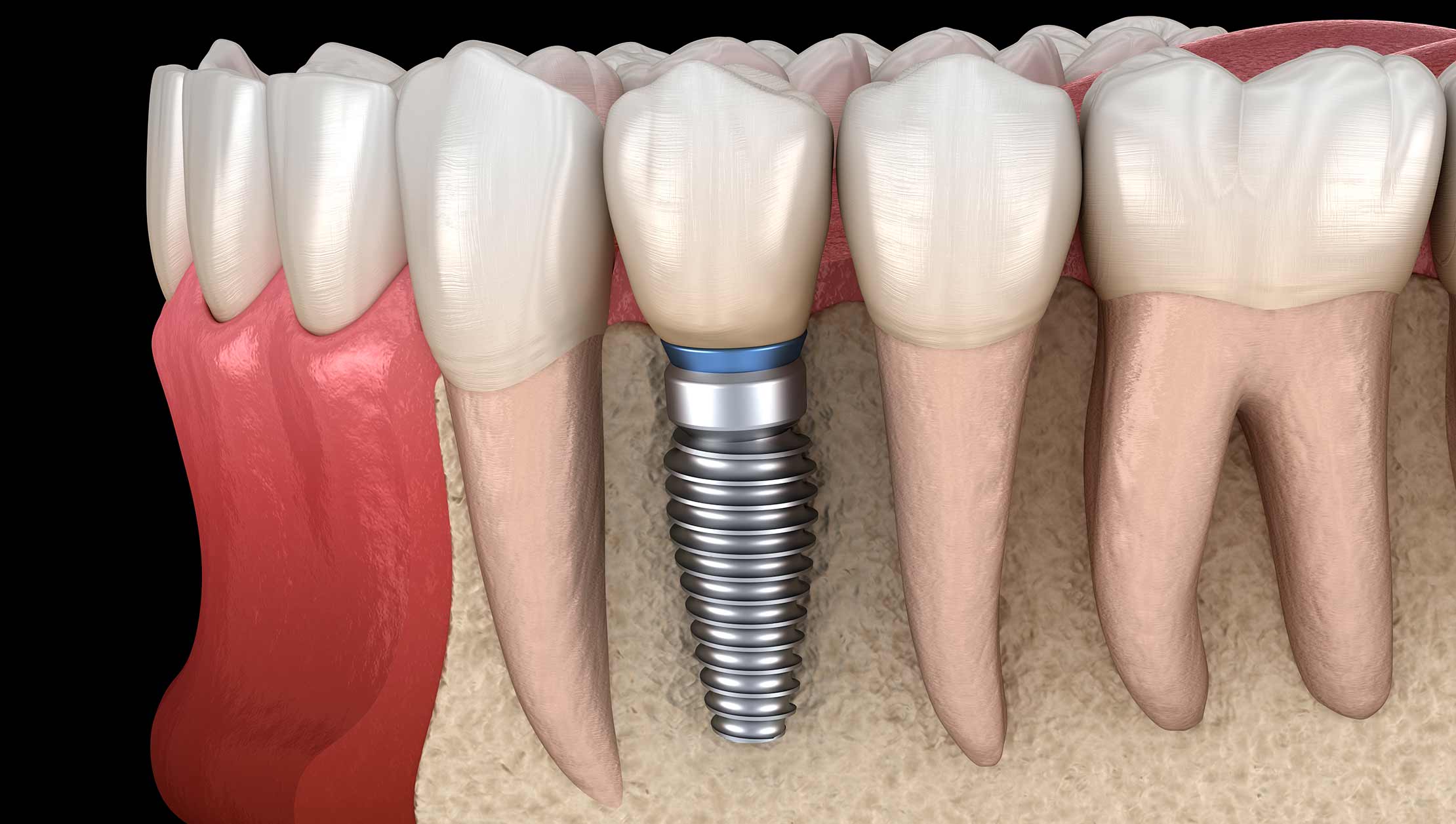 titanium implants