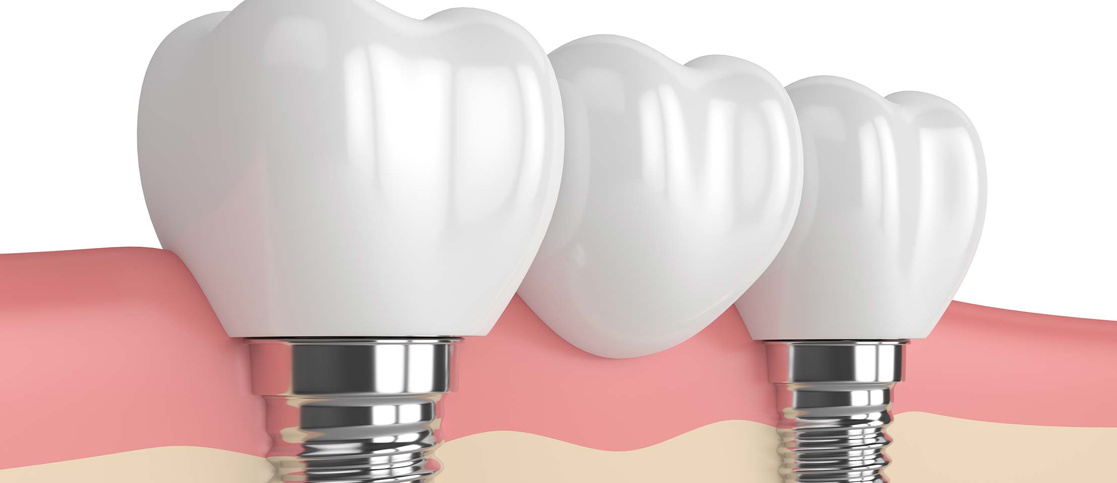 Zahnimplantate