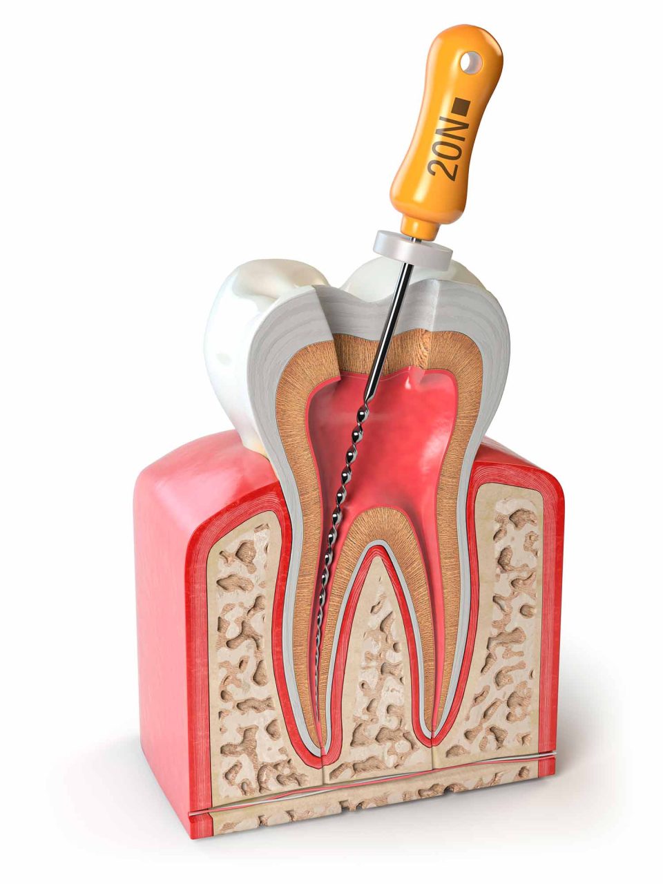 root canal treatment