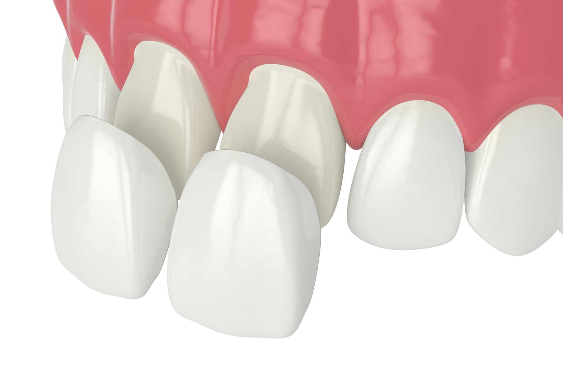 cosmetic dental restorations